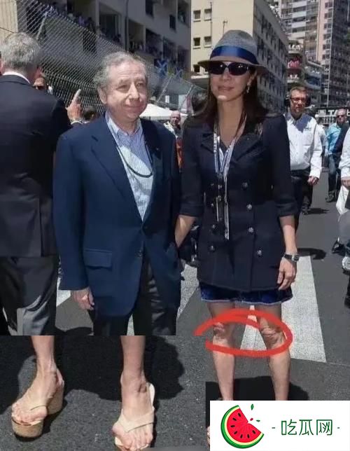 楊紫瓊腳趾頭外翻近照?qǐng)D片，是什么原因造成的？